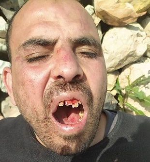 Moussa Qattash after being physically assaulted Moussa Qattash after being physically assaulted