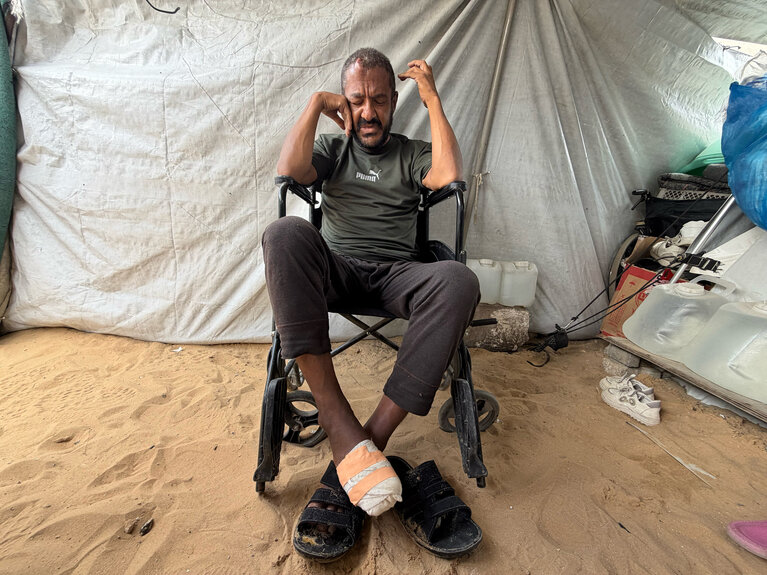 Basel, a displaced Palestinian, developed an infection in his right foot after being bitten by a rat. Photo by OCHA